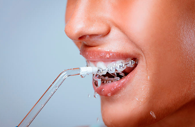 Best Water Flossers for Braces  